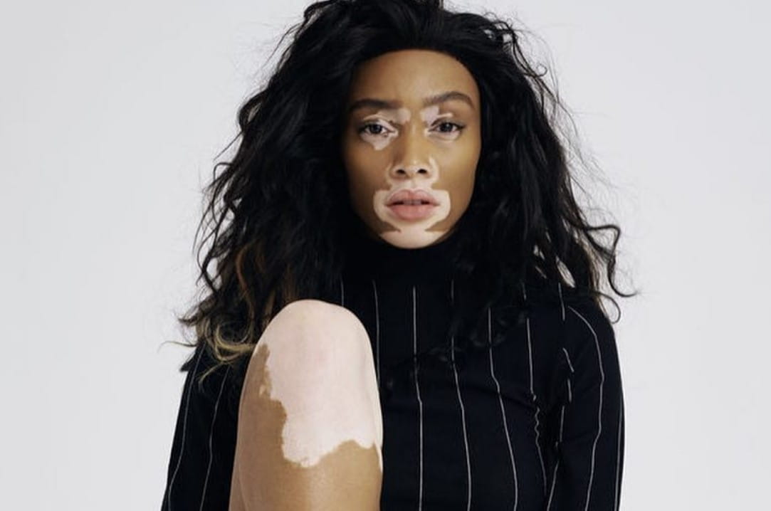 Winnie Harlow