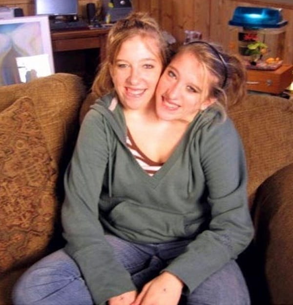 30 cose interessanti sulle gemelle siamesi Abby e Brittany H